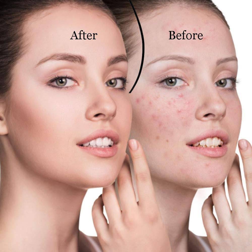 Lightweight blackhead removal tool for an easy skincare routine