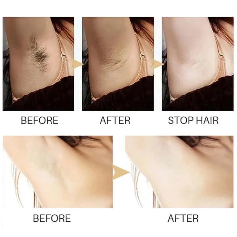 Effective hair removal solution for arms, legs, and armpits