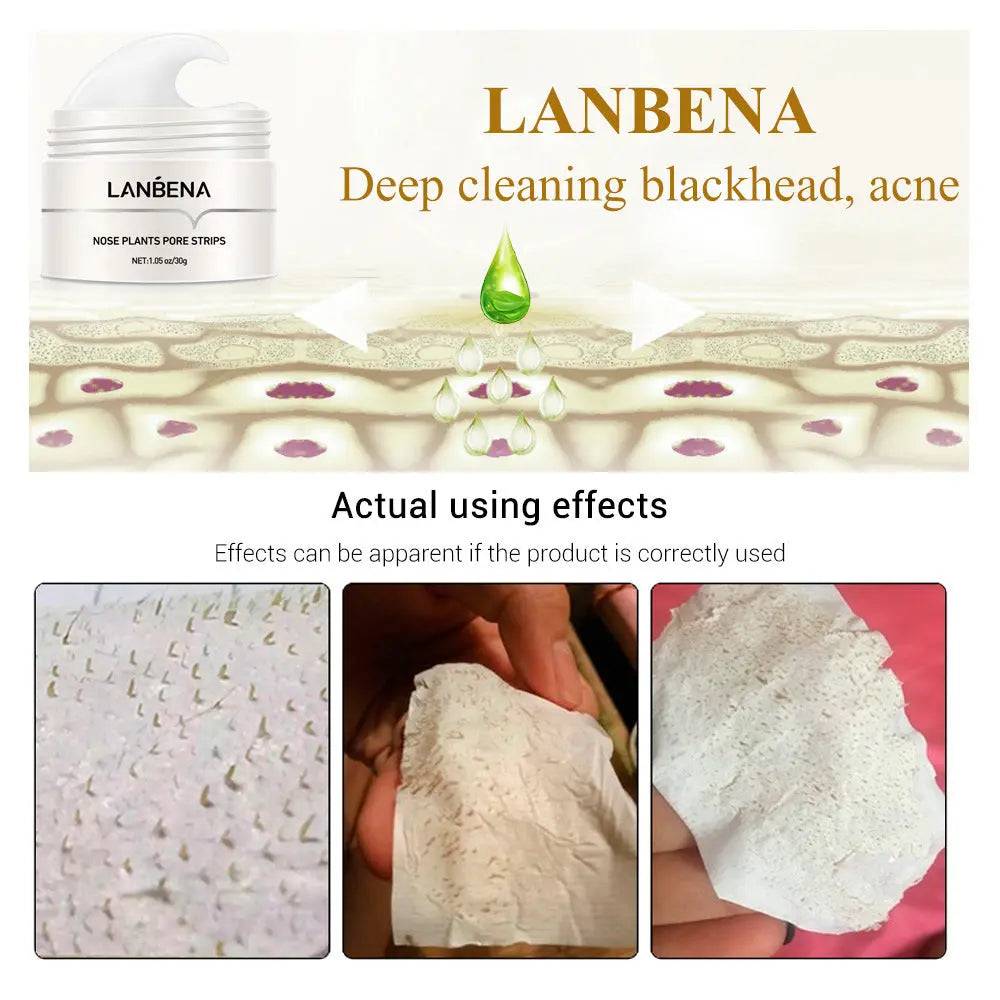 Effective blackhead treatment for all skin types and acne care  